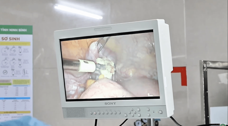 Xử lý ứ dịch vòi trứng – Bước chuẩn bị quan trọng nâng cao tỷ lệ thành công thực hiện IVF